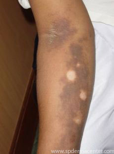 PIH-Before